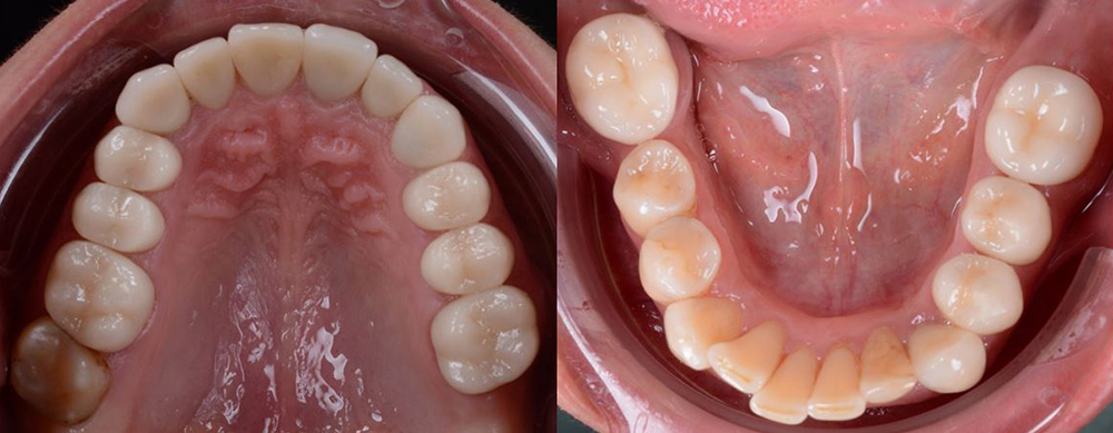  Final – upper and lower dental arcade