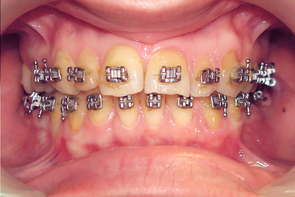  Intermediary – orthodontics