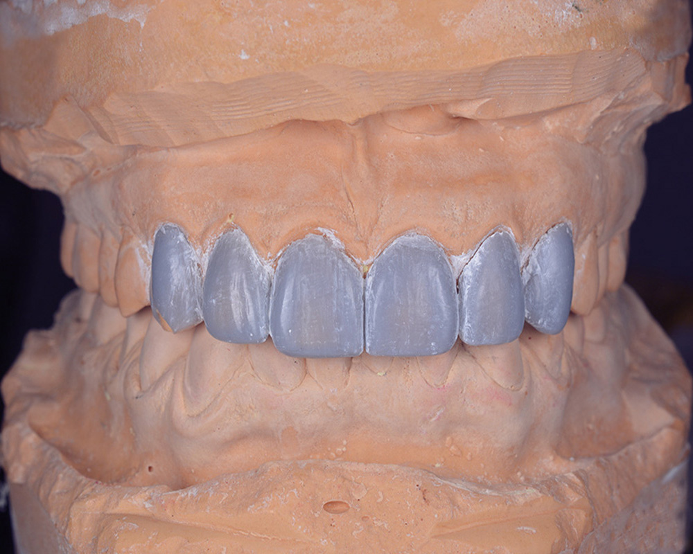  Wax-up of frontal upper teeth