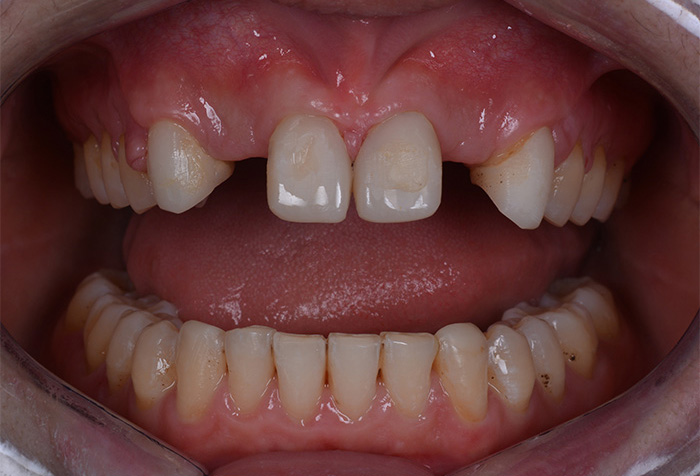  Temporary front upper frontal teeth and insertion of implants