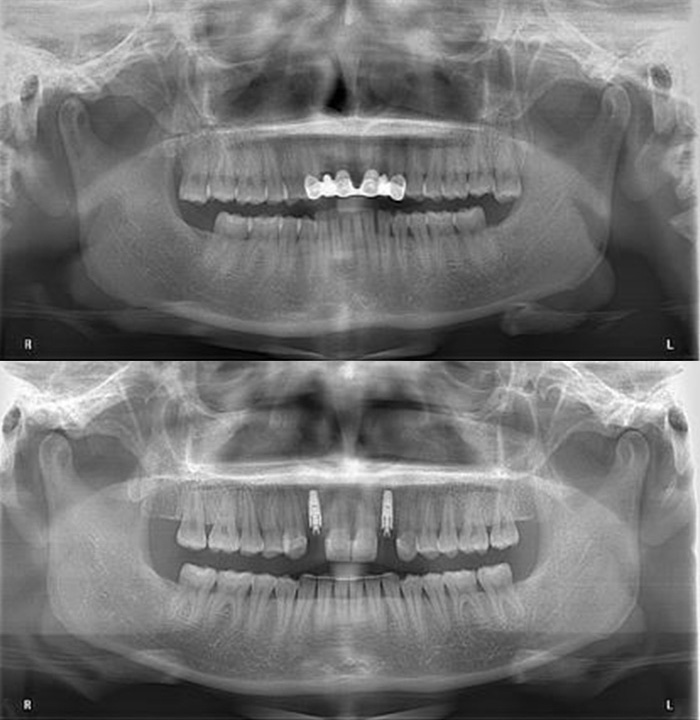  OPG – initial and post-orthodontic treatment and surgery