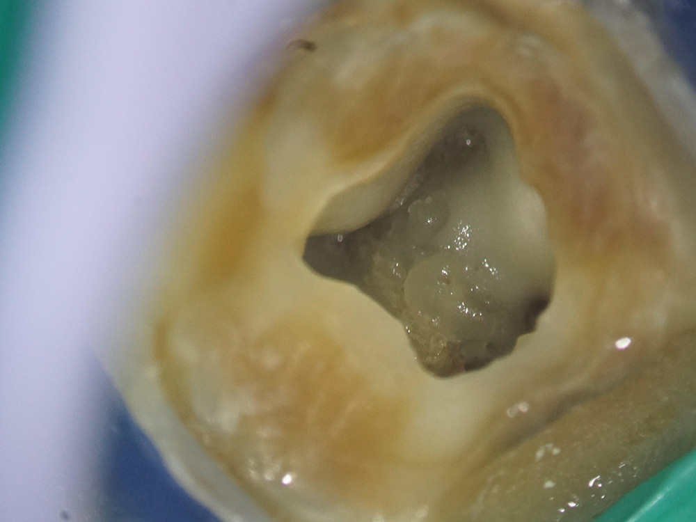  Denticles (calcium and phosphorus deposits on the pulp tissue, caused by irritating factors).