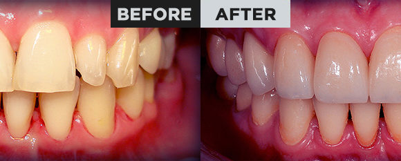 Orthodontics and total rehabilitation
