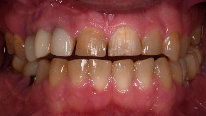  Provisional crowns