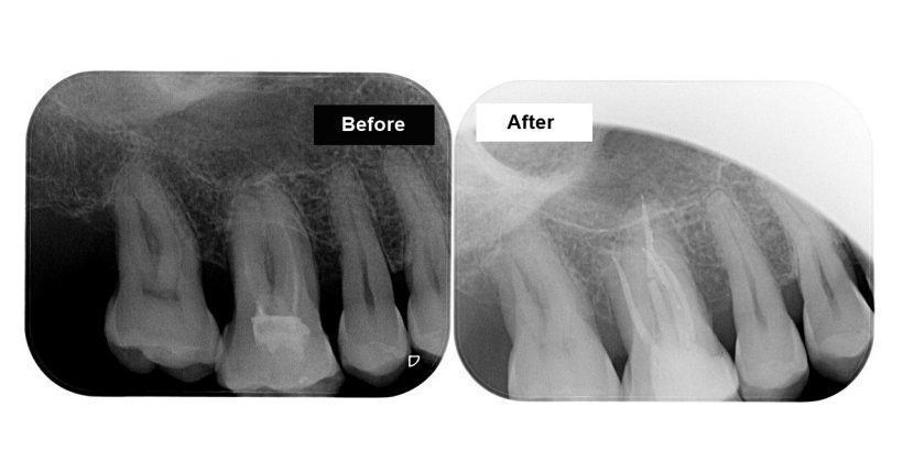 Tooth with an incomplete endo treatment requiring prosthetic rehabilitation