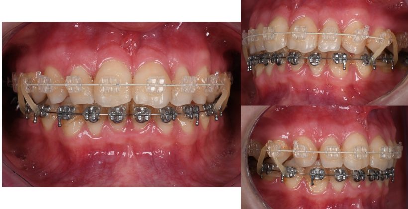  Orthodontic treatment
