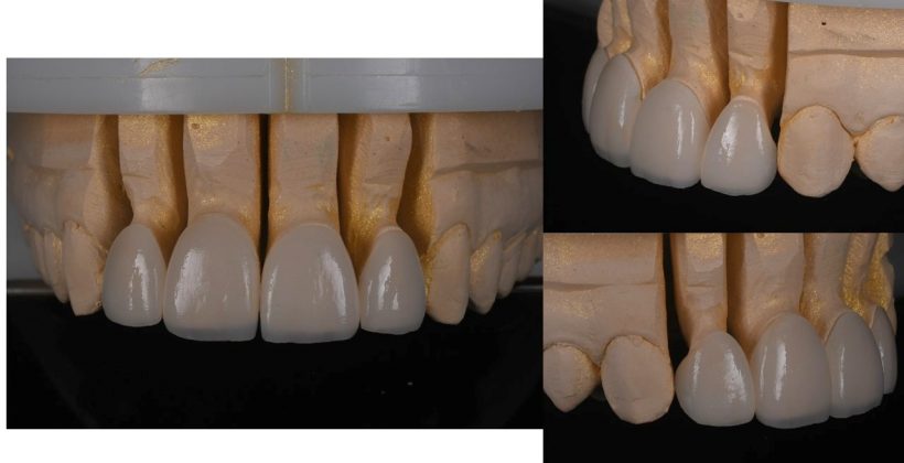  Final dental veneers on the model