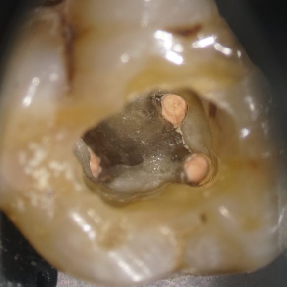  Appearance of the pulp chamber of the blocked tooth