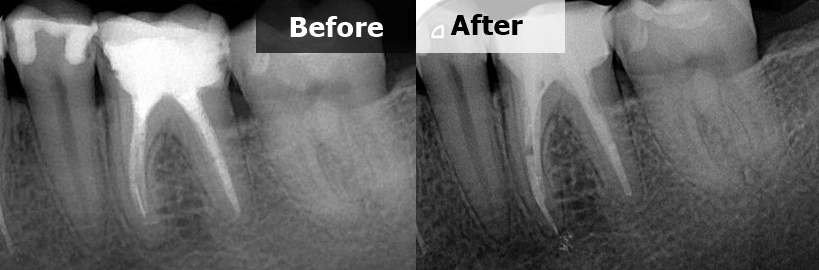 Retreatment 36 with fractured instrument on the mesial root