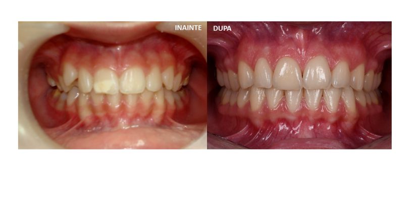 Tratament ortodontic si fatetare 11
