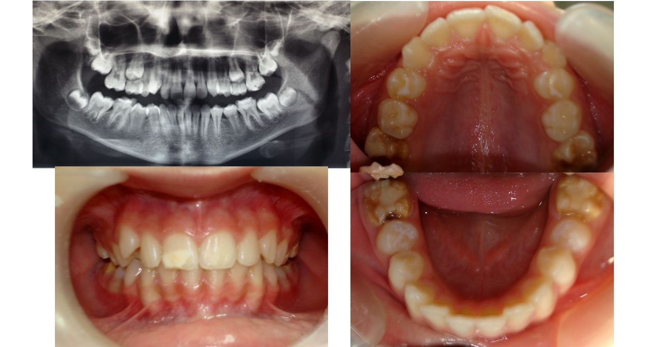  The patient presents in the clinic with advanced destruction of all 4 definitive molars. We present the case of the patient started at the age of 9 years and completed at the age of 18 years.