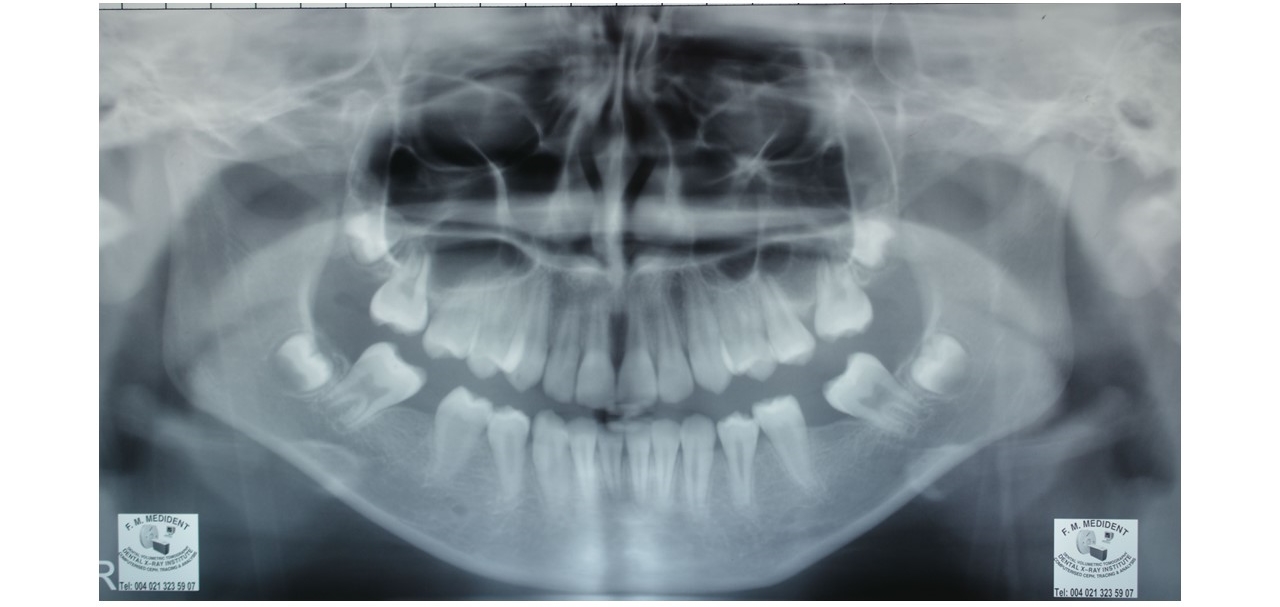  Due to the presence of the buds of the molars 3, it is decided to extract the molars 1 and then to close the spaces with the help of the brackets.