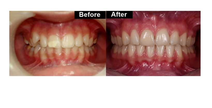 Orthodontic treatment and veneers 11