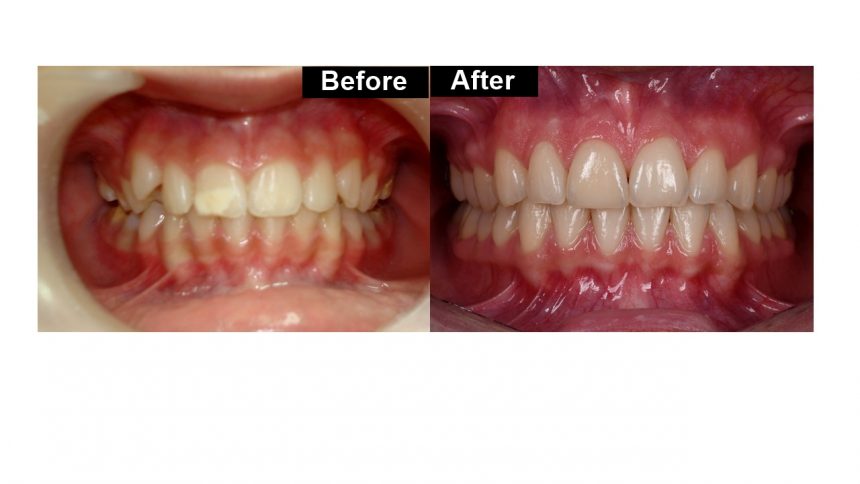 Orthodontic treatment and veneers 11