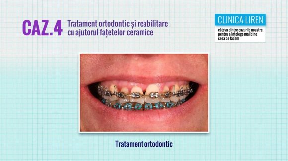 Tratament ortodontic si reabilitare