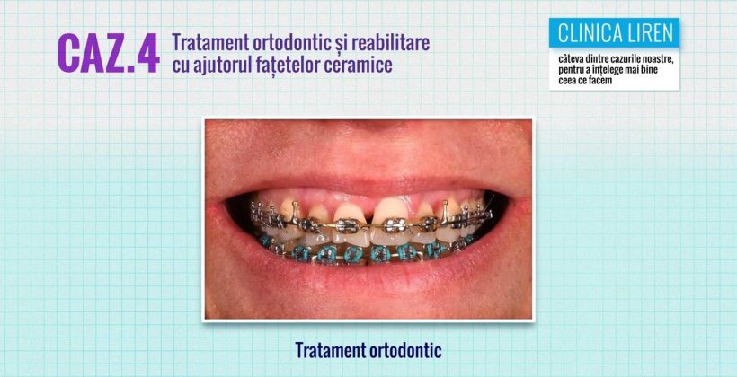 Tratament ortodontic si reabilitare