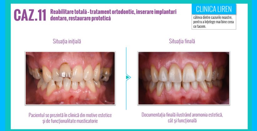 Caz #11. Reabilitate totala prin ortodontie, implanturi si protetica