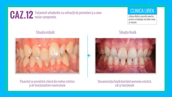 Caz #13 Tratament de reabilitare: Protetică fixă pe dinți și implanturi dentare.