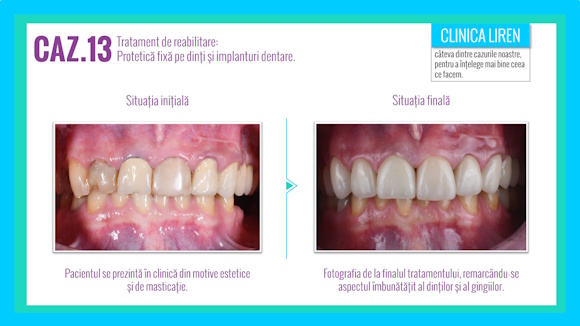 Case #13. Rehabilitation treatment – prosthetics and dental implants