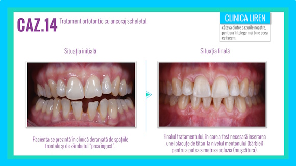 Case #14. Orthodontic treatment with skeletal anchorage