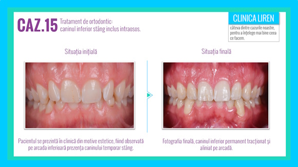 Case #15. Orthodontic treatment – impacted canine