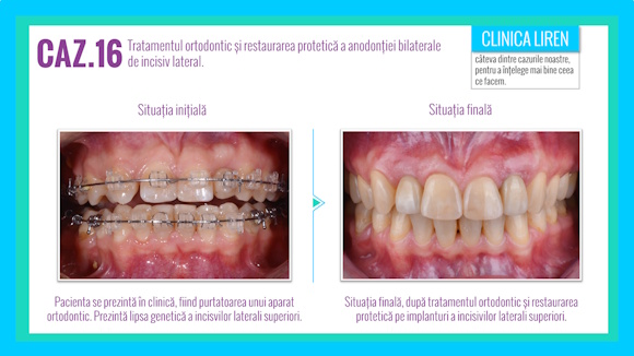 Case #16. Orthodontic treatment and prosthetic restoration of bilateral lateral incisor anodontia